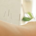 Acupunctueel Acupunctuurbehandeling